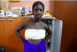 Aisha con il suo seno coperto dopo la medicazione